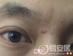 灵犀痦子课堂:痦子和痣的区别图解
