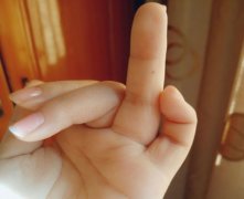 灵犀痣的位置与命运课堂:手掌手心上长痣命运好吗