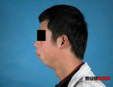 男人没有下巴
