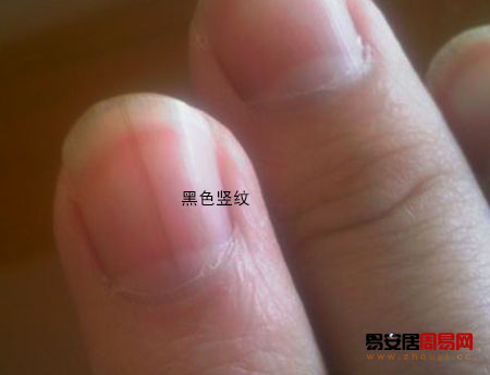 指甲黑色竖纹